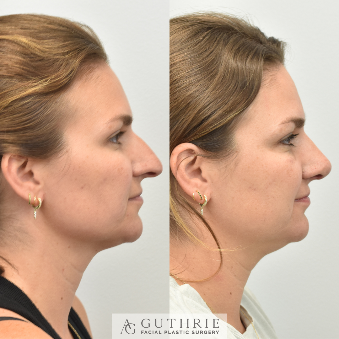 Before and After Rhinoplasty