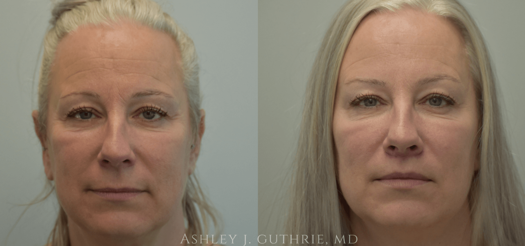 before and after pictures of female lip flip patient
