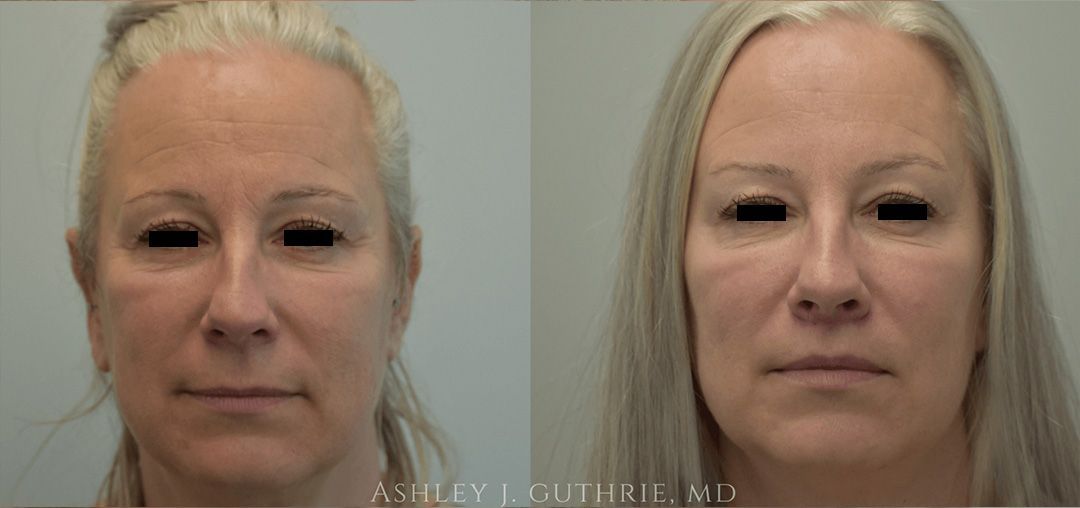 woman before and after lip flip procedure