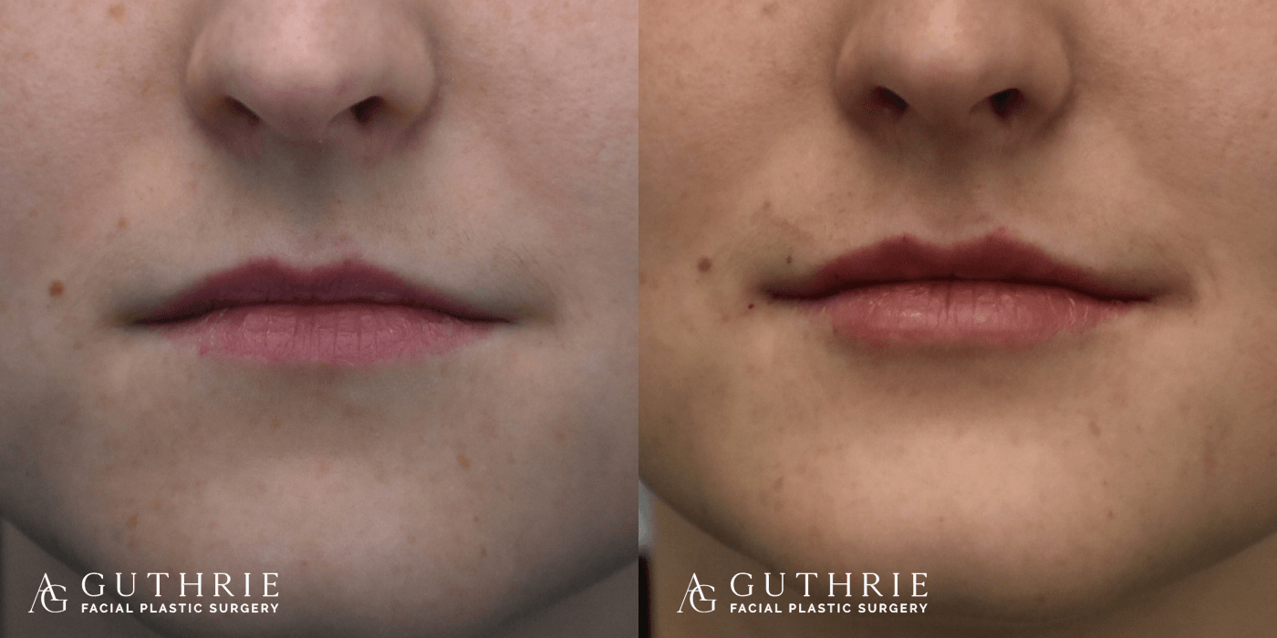 female patient Before and After lip fillers by Dr. Ashley Guthrie
