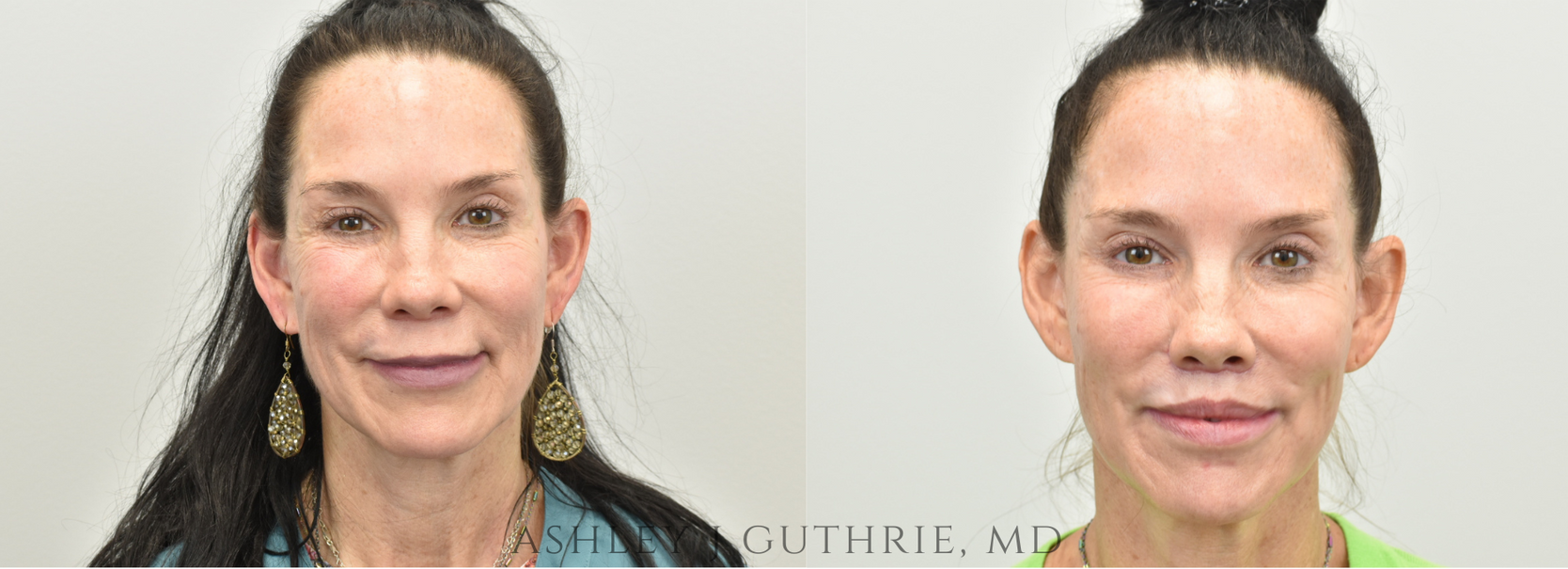 Lip Lift by Ashley Guthrie MD - Facial Plastic Surgeon