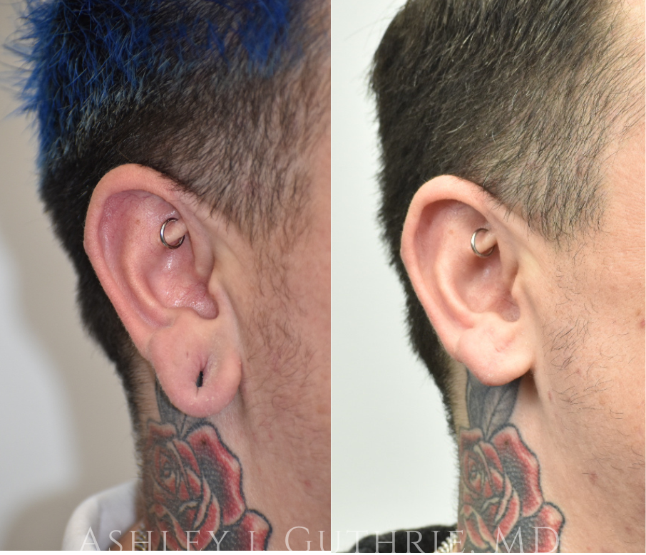 closeup of ears Before and After Earlobe Repair