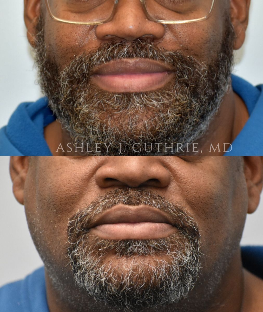 Before and After Lip Reduction