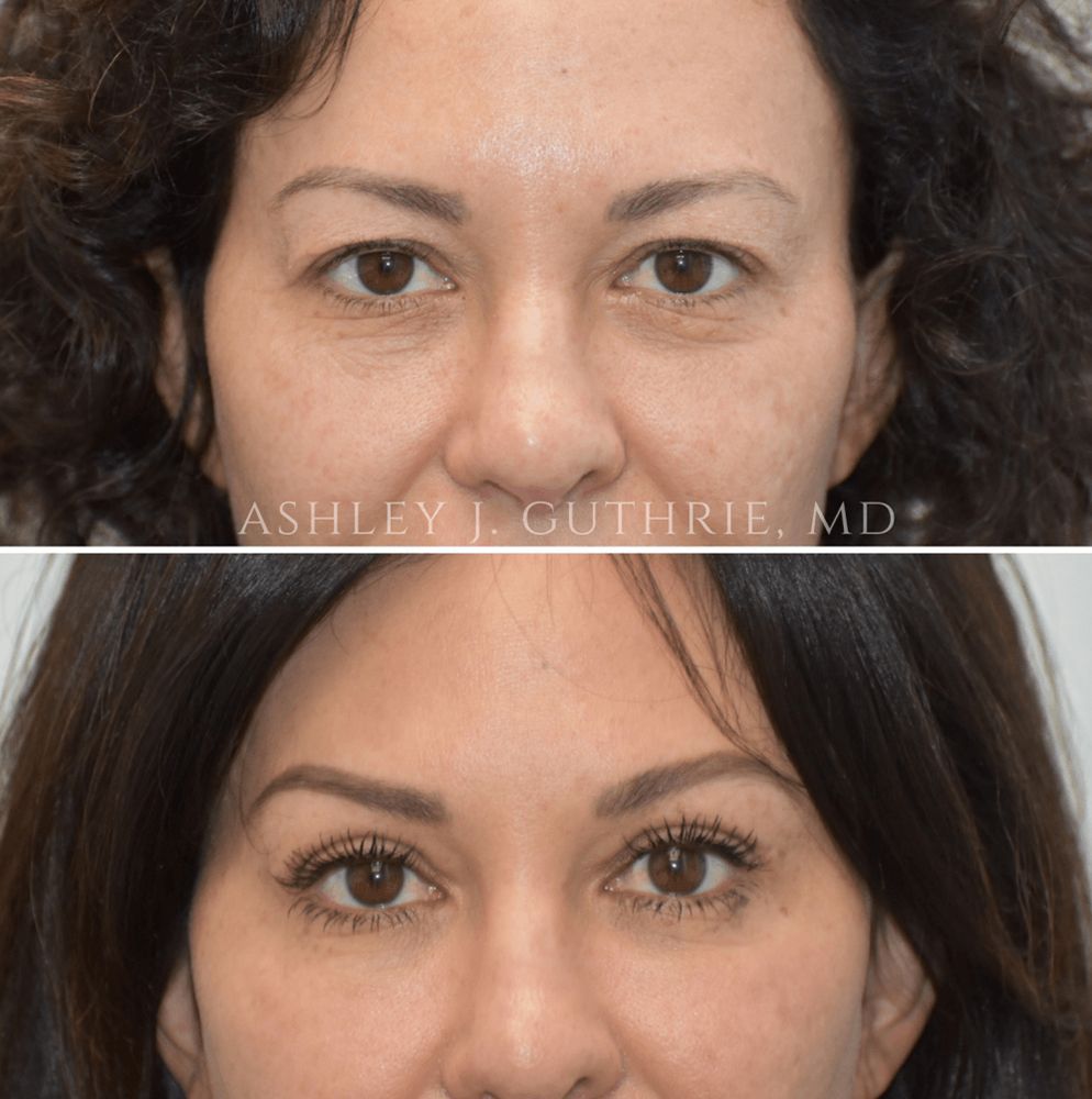 Before and After Upper Blepharoplasty