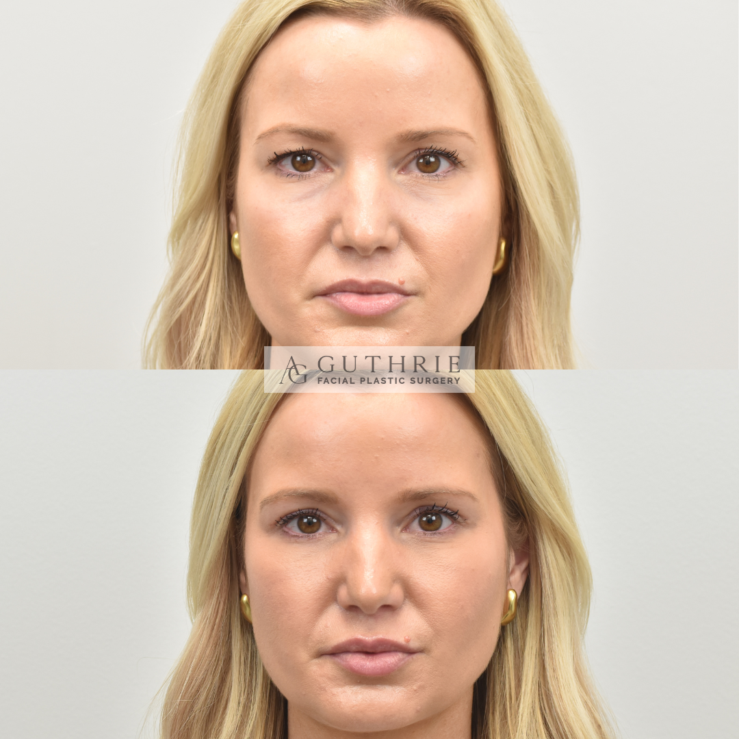 patient at guthrie facial plastic surgery before and after lower and upper blepharoplasty brentwood tn