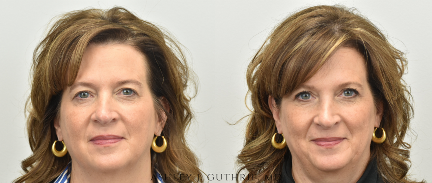 Blepharoplasty - Before and After