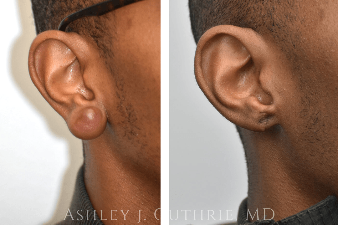 Before and 6 Weeks After Keloid Excision and Earlobe Repair