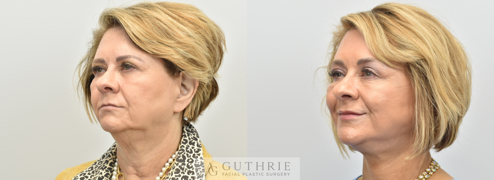 a woman's face before and after facelift performed by Dr. Ashley Guthrie