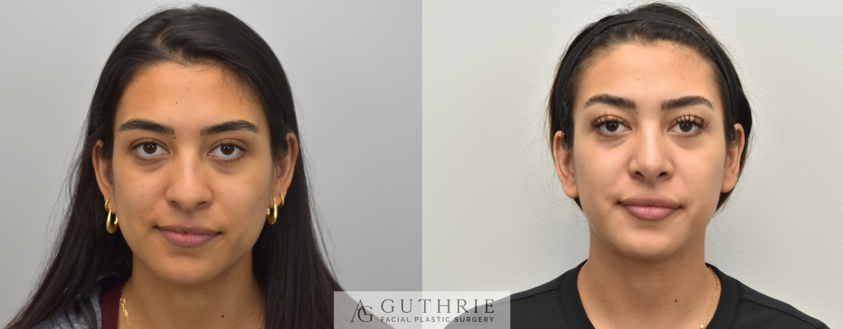 a young woman before and after Rhinoplasty