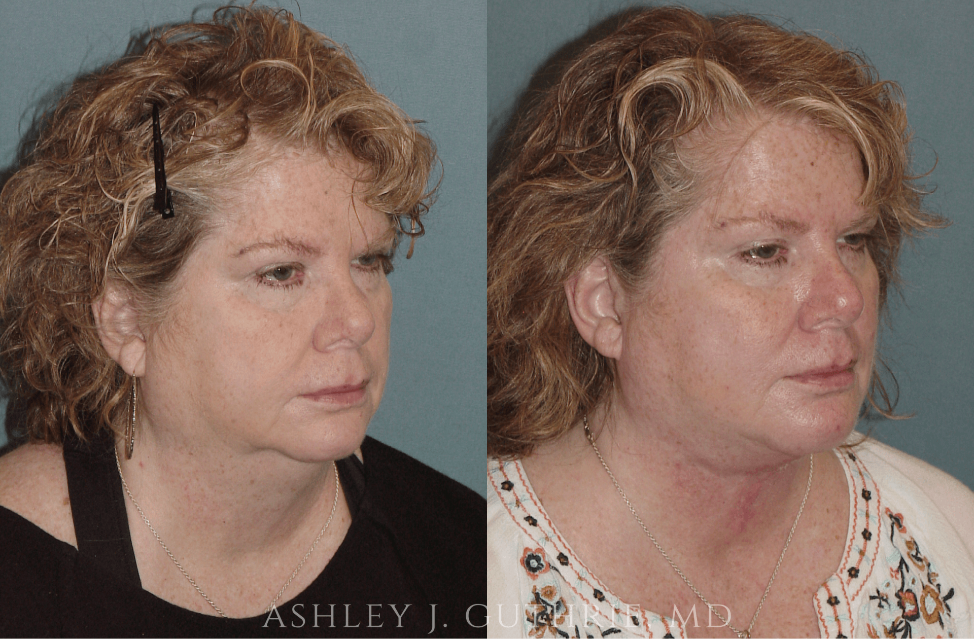 a before and after photo of a woman 's face and neck .