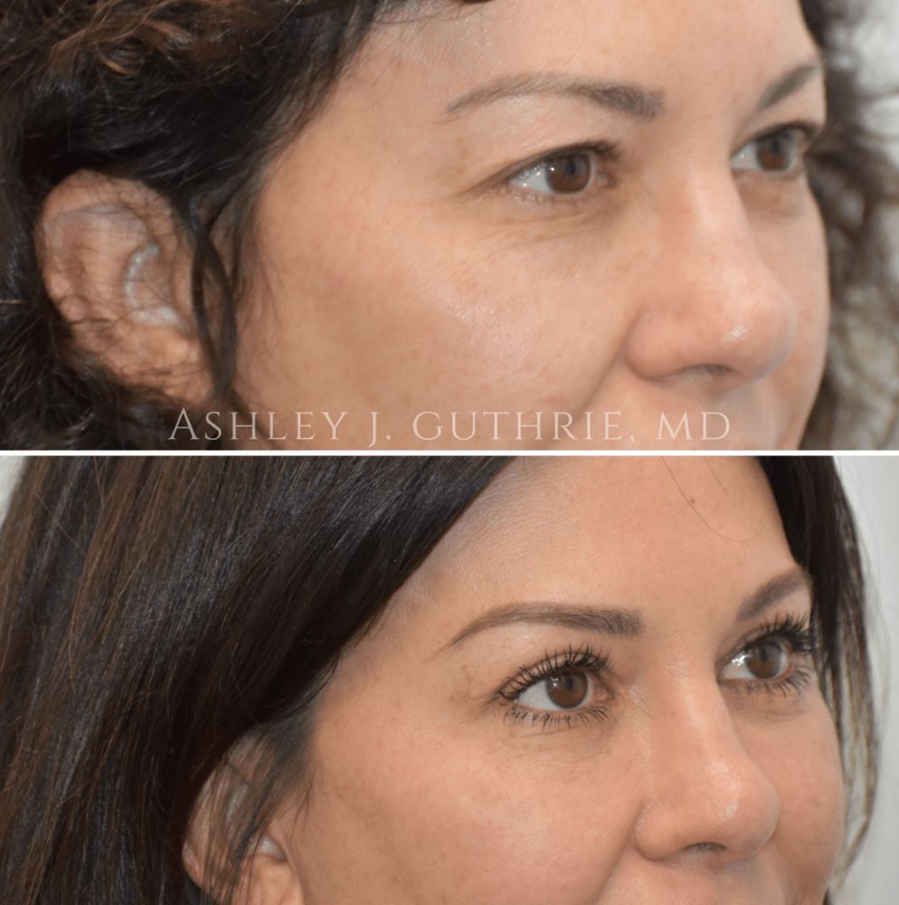 a woman before and after blepharoplasty