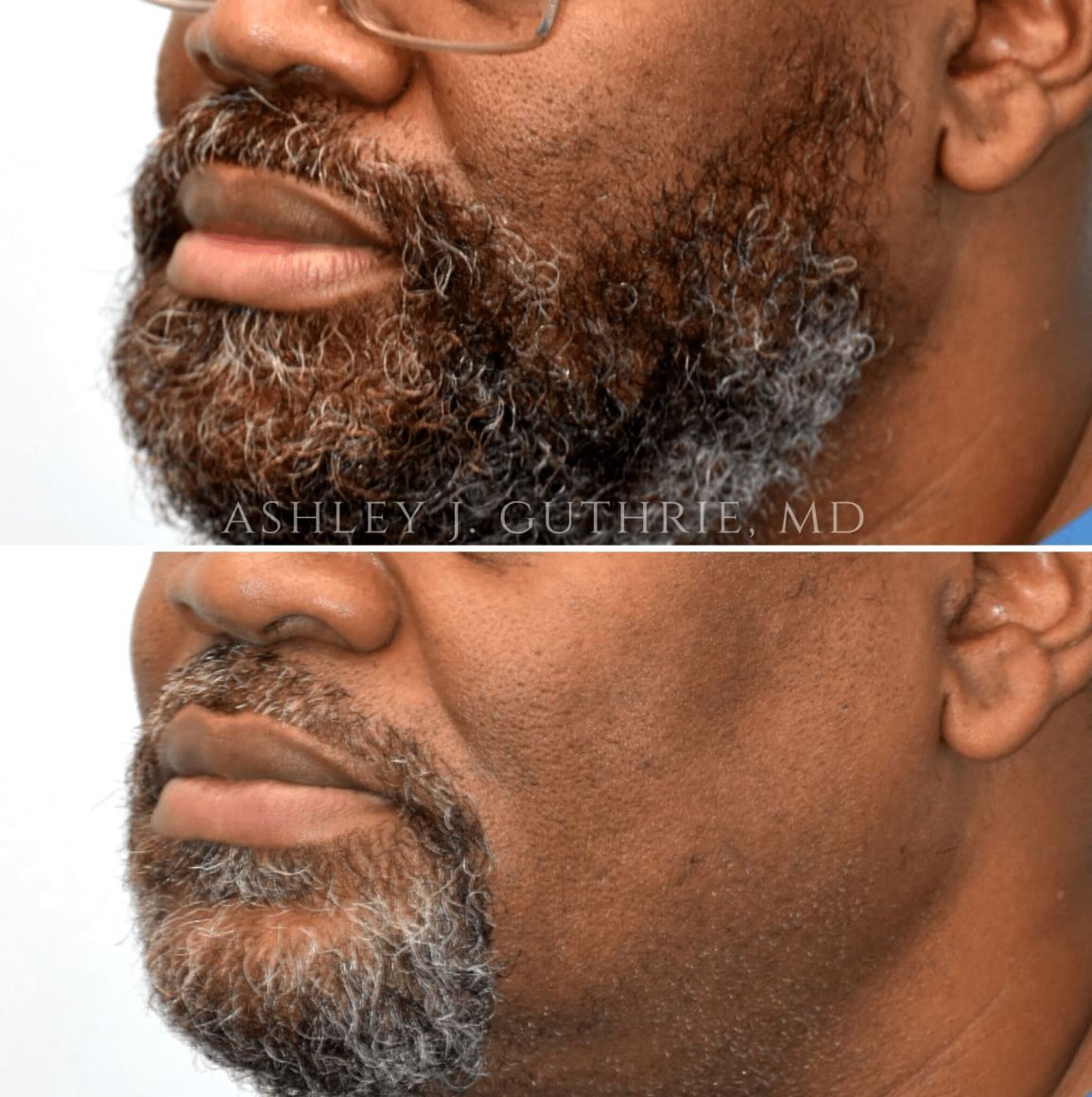 closeup of man's lips before and after lip reduction surgery