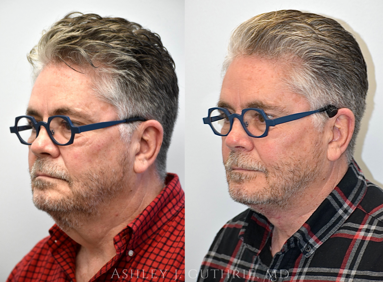 a man before and after direct submental cervicoplasty