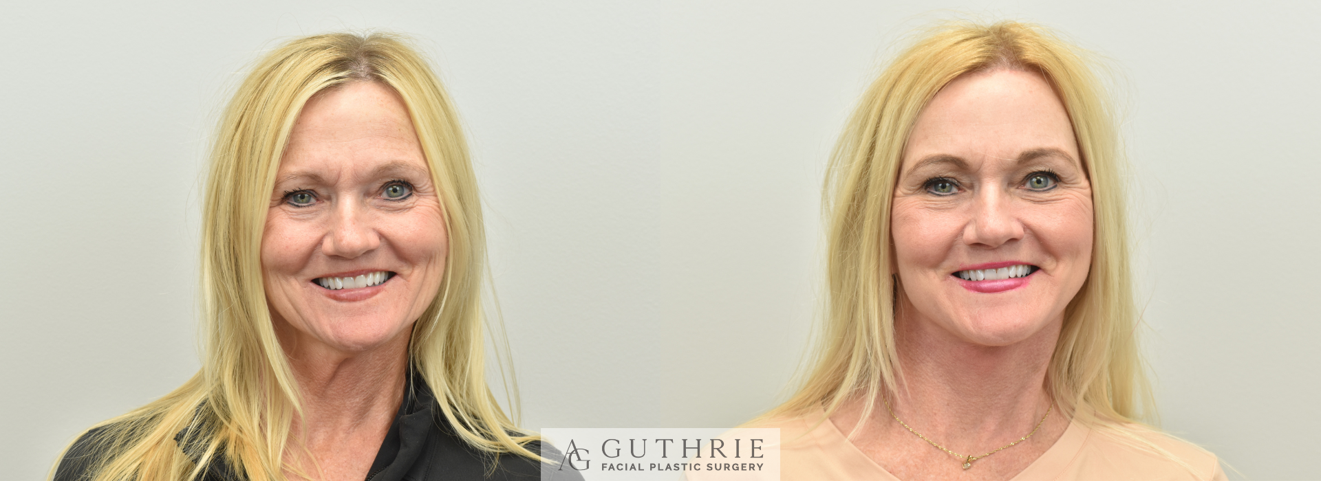 Dr. Guthrie's actual patient - before and after Deep Plane Face and Neck Lift, Brow Lift, CO2 Laser.