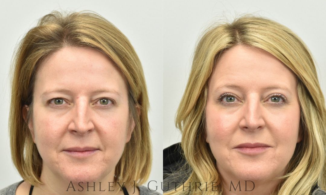 Before and After Upper Blepharoplasty