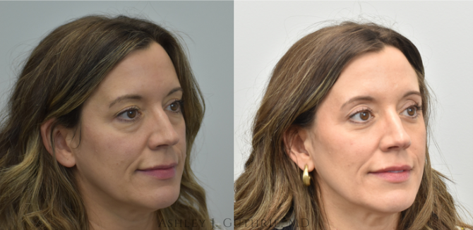 a woman before and after lower blepharoplasty