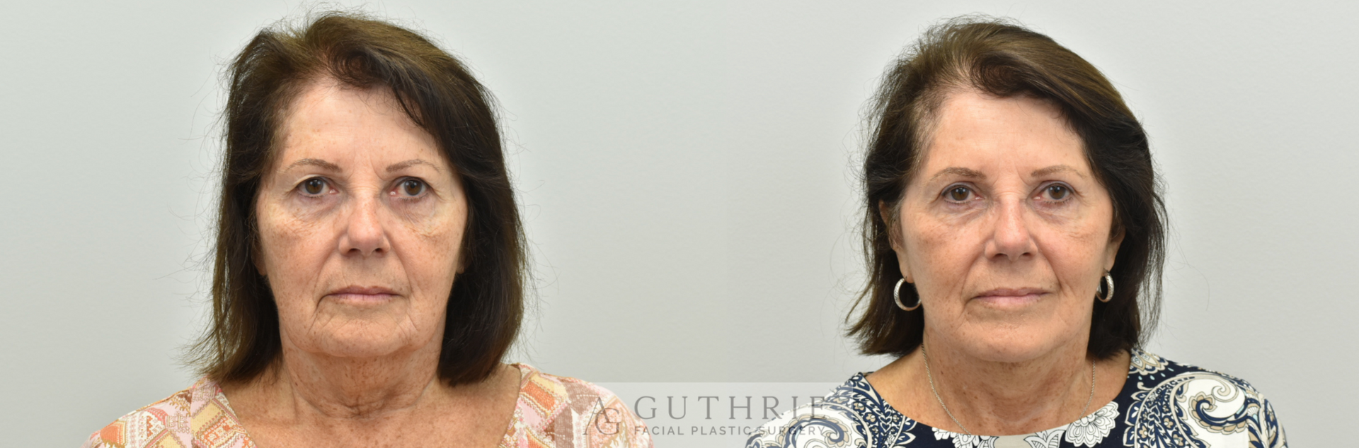 Before and After Facelift, Upper Blepharoplasty, Endoscopic Brow Lift, CO2 Laser
