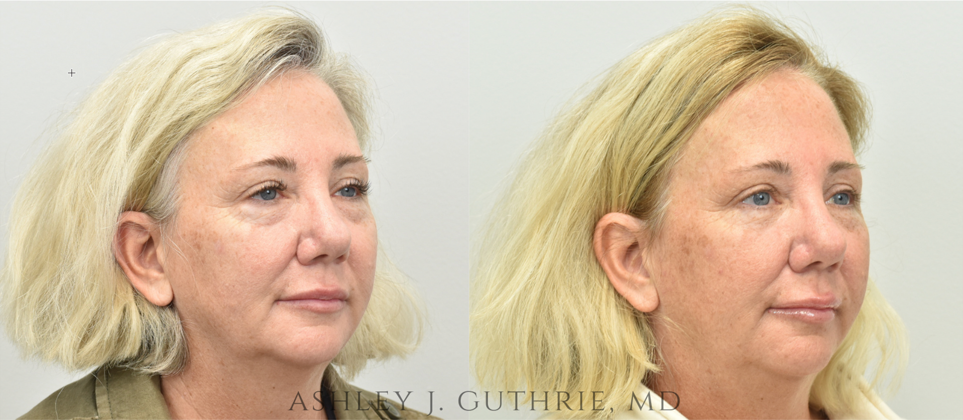 a woman before and after lower blepharoplasty