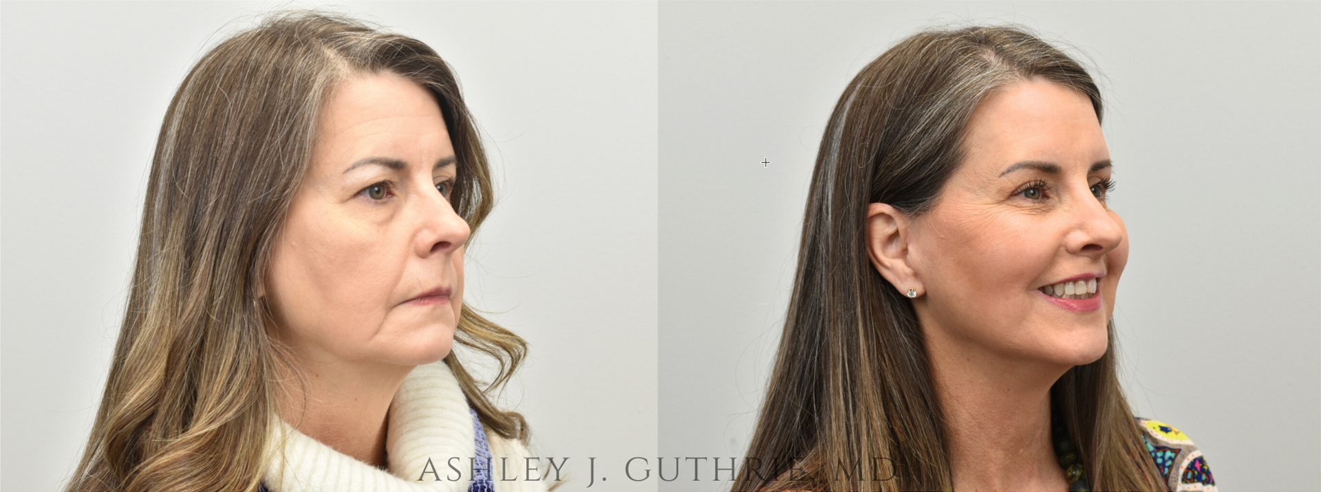 a woman's face before and after facelift performed by Dr. Ashley Guthrie
