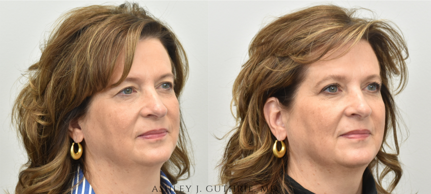 a woman before and after upper blepharoplasty