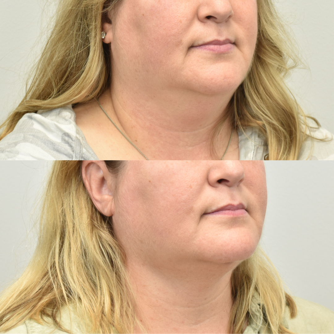 woman's face before and after FaceTite treatment