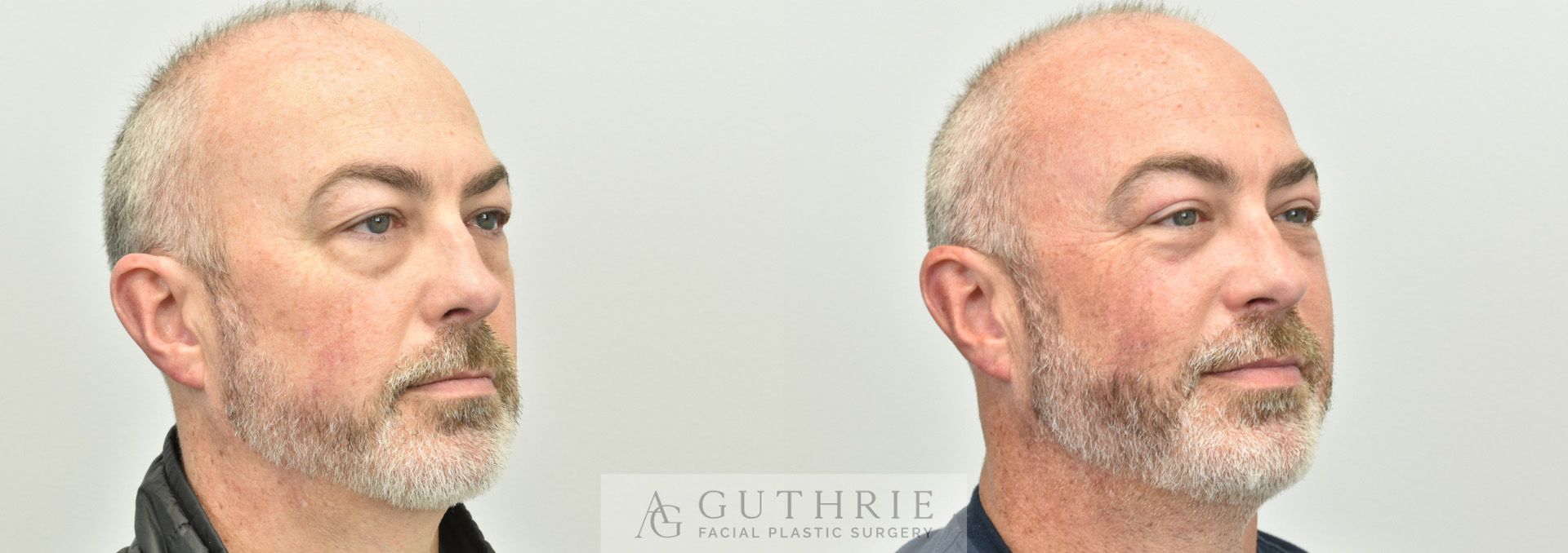 a man before and after upper and lower blepharoplasty