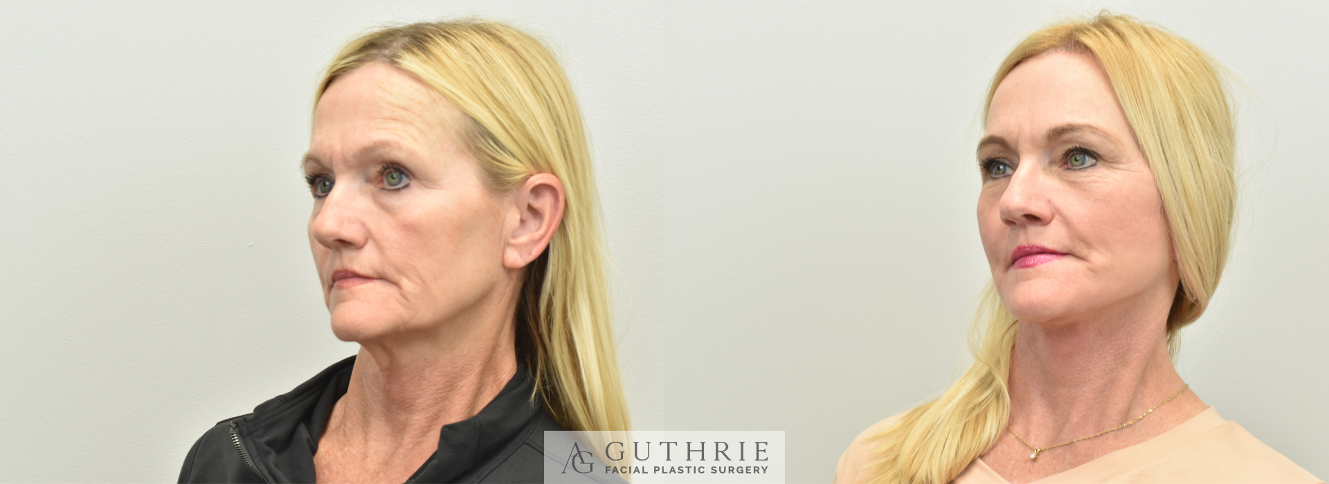 Dr. Guthrie's actual patient - before and after Deep Plane Face and Neck Lift, Brow Lift, CO2 Laser.