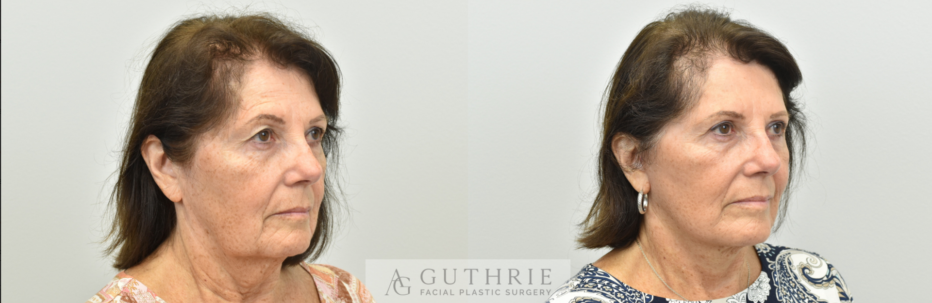 a woman's face before and after facelift procedure