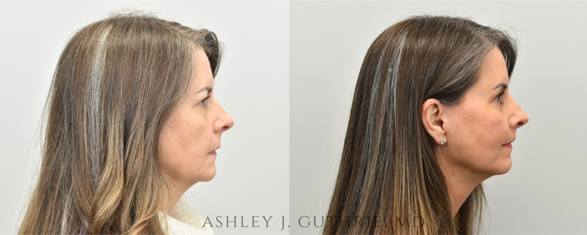 Facelift / Deep Plane - Before & After