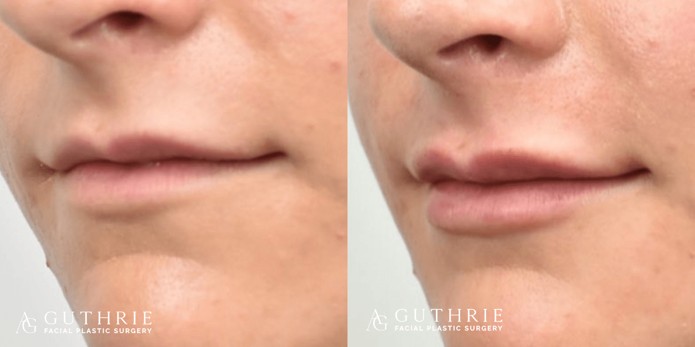 closeup of patient's mouth before and after lip filler injection