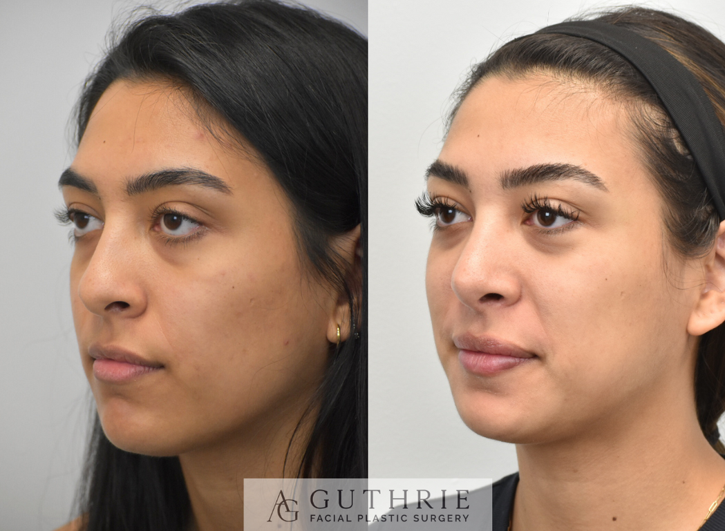 a woman's face before and after rhinoplasty