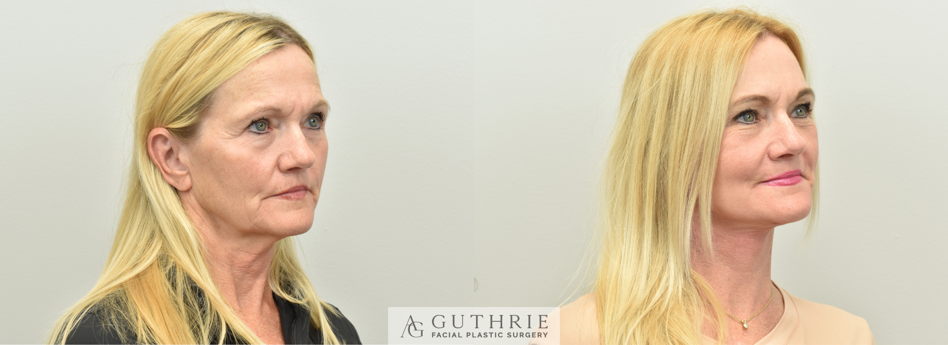 Dr. Guthrie's actual patient - before and after Deep Plane Face and Neck Lift, Brow Lift, CO2 Laser.