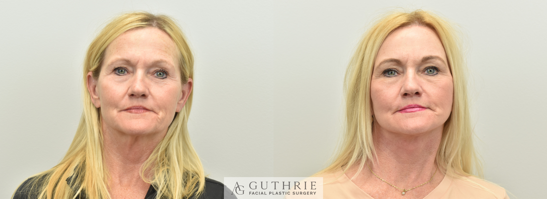 Dr. Guthrie's actual patient - before and after Deep Plane Face and Neck Lift, Brow Lift, CO2 Laser.