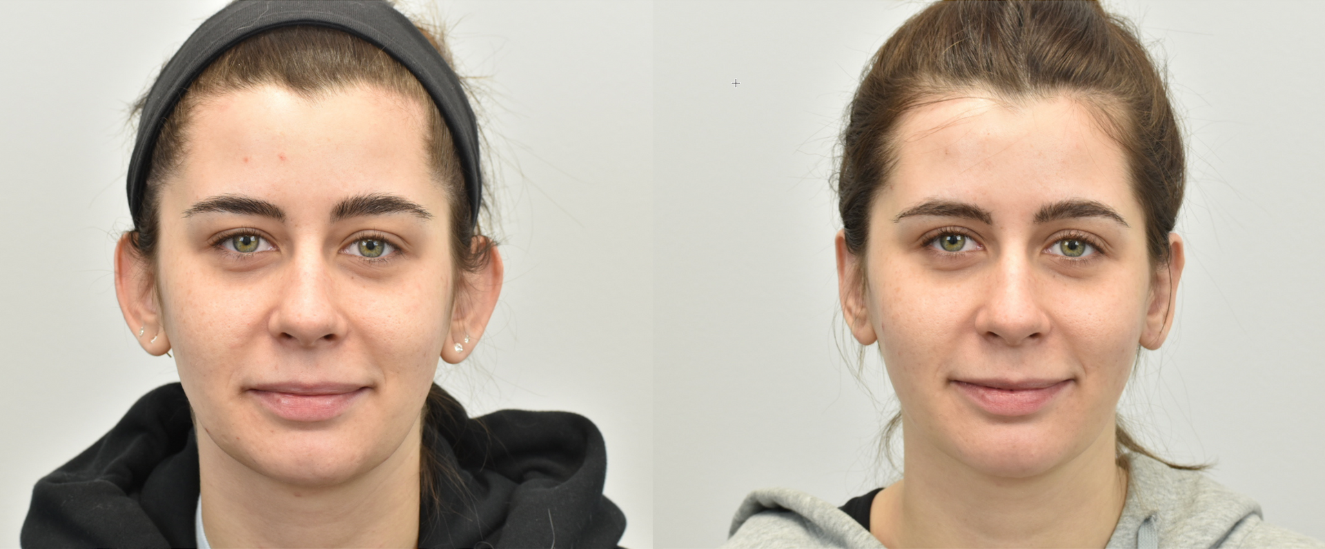 a before and after photo of a woman's face after otoplasty procedure