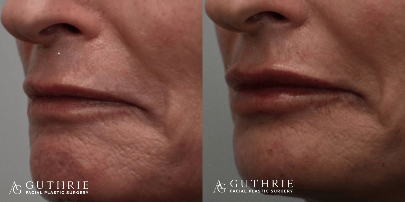 closeup of patient's mouth before and after lip filler injection