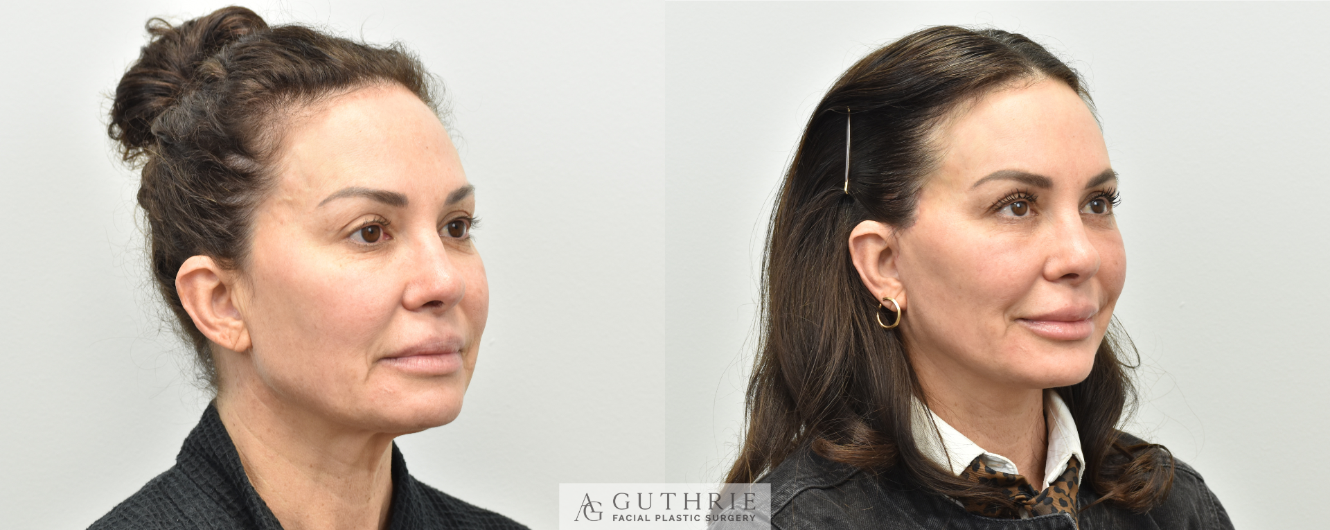 Before and After Facelift