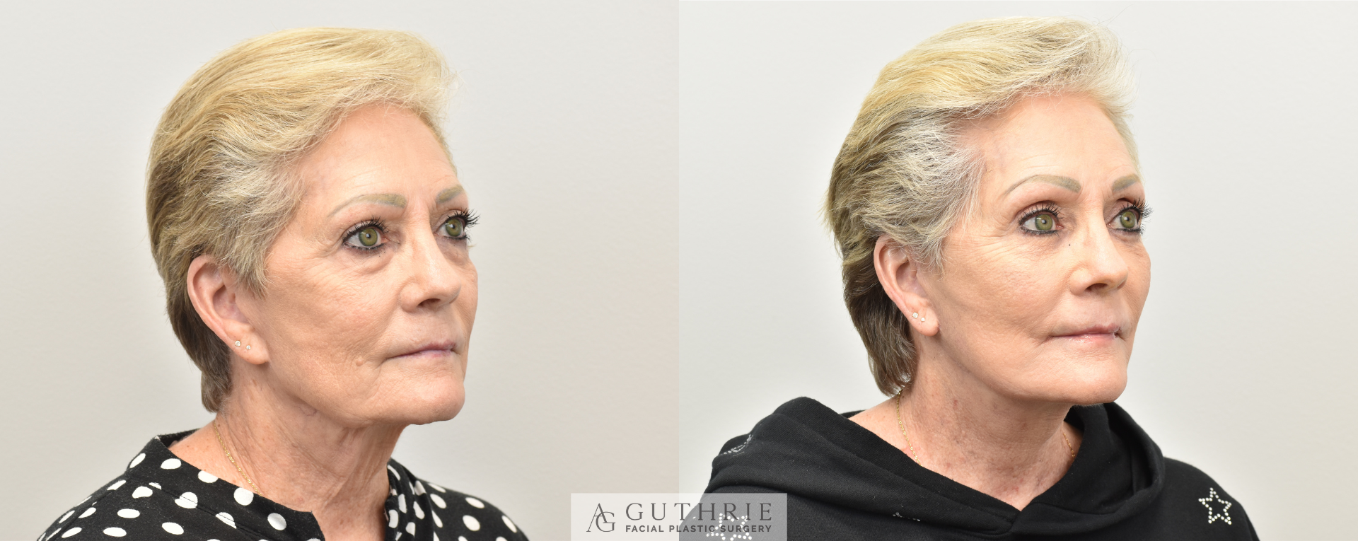 Before and After Deep Plane Face and Neck Lift, Endoscopic Brow Lift, Lower Blepharoplasty, Fat Grafting, and CO2 Laser