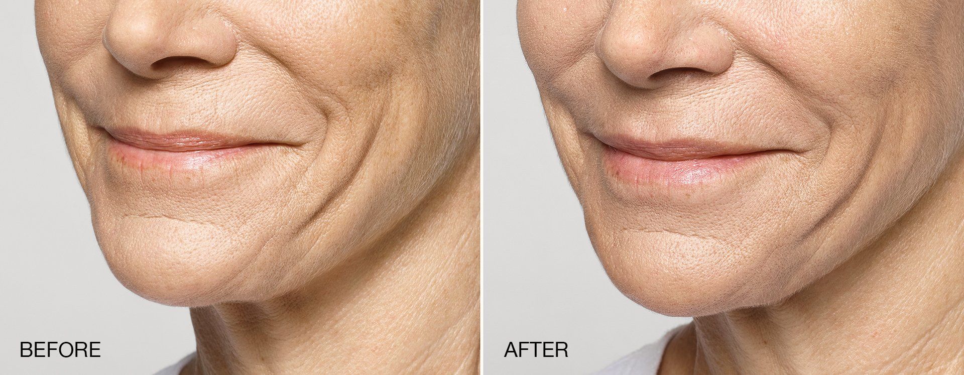 Before and after  - Dermal Fillers - Smiling Person