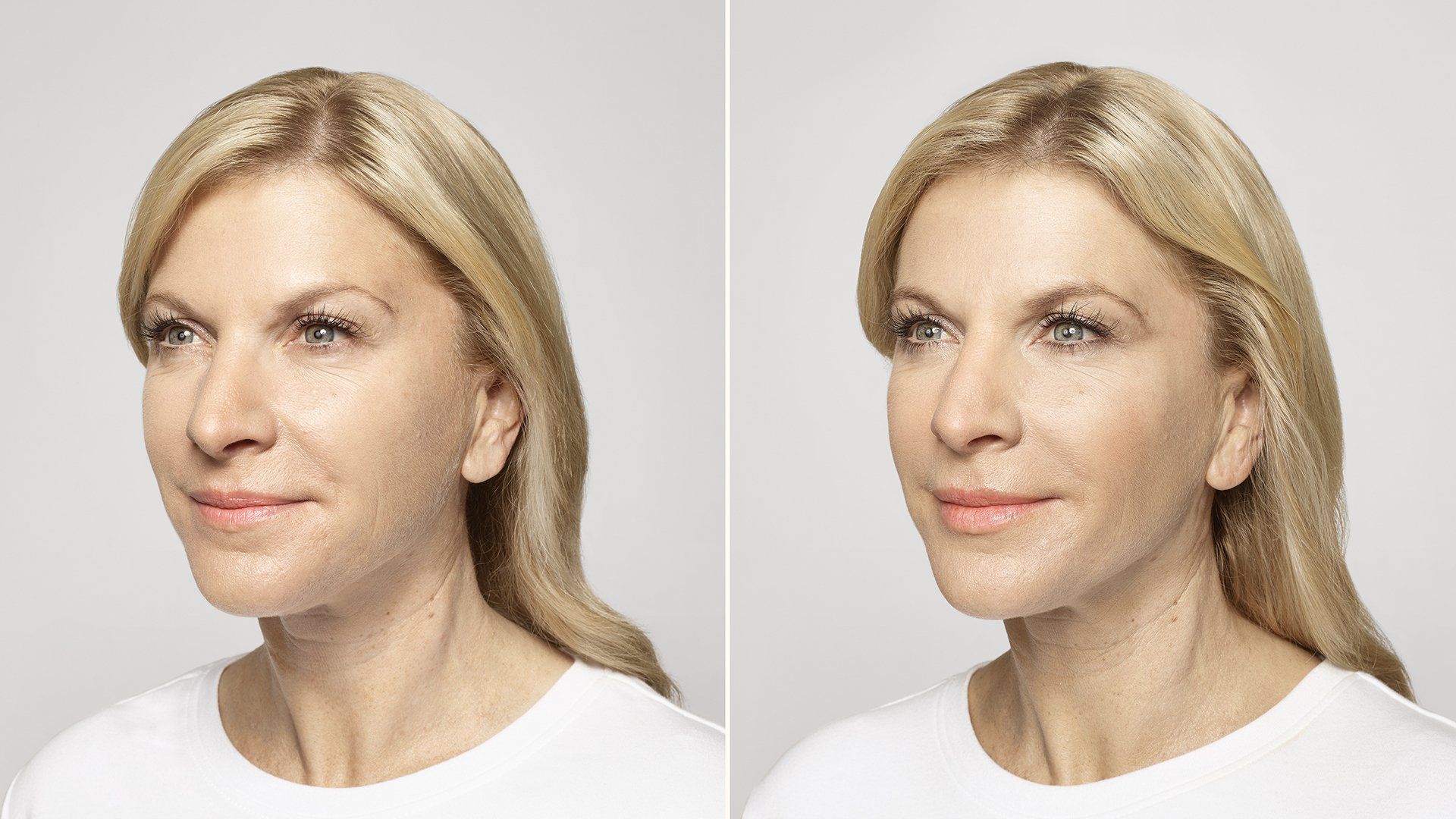 patient before and after treatment with the Restylane collection of fillers
