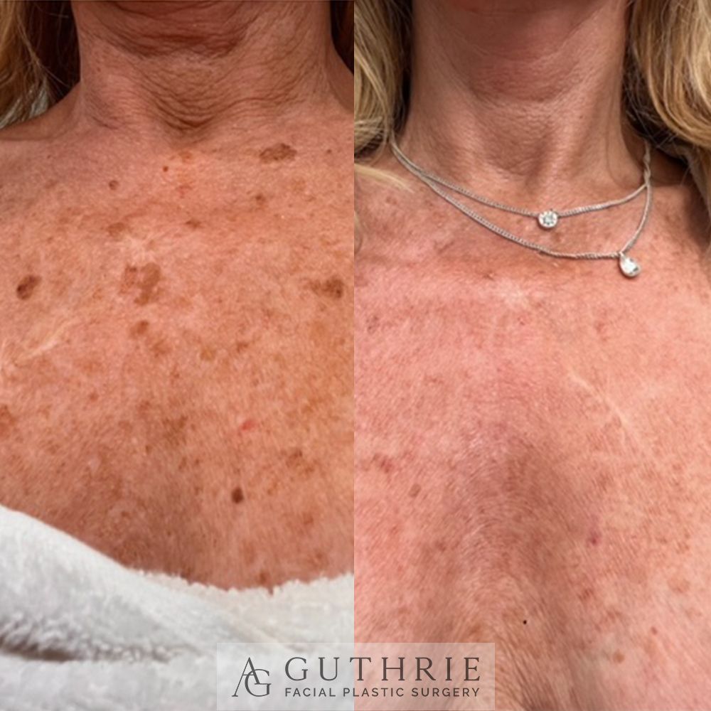 closeup of woman's decolette before and after treatment with CO2 laser