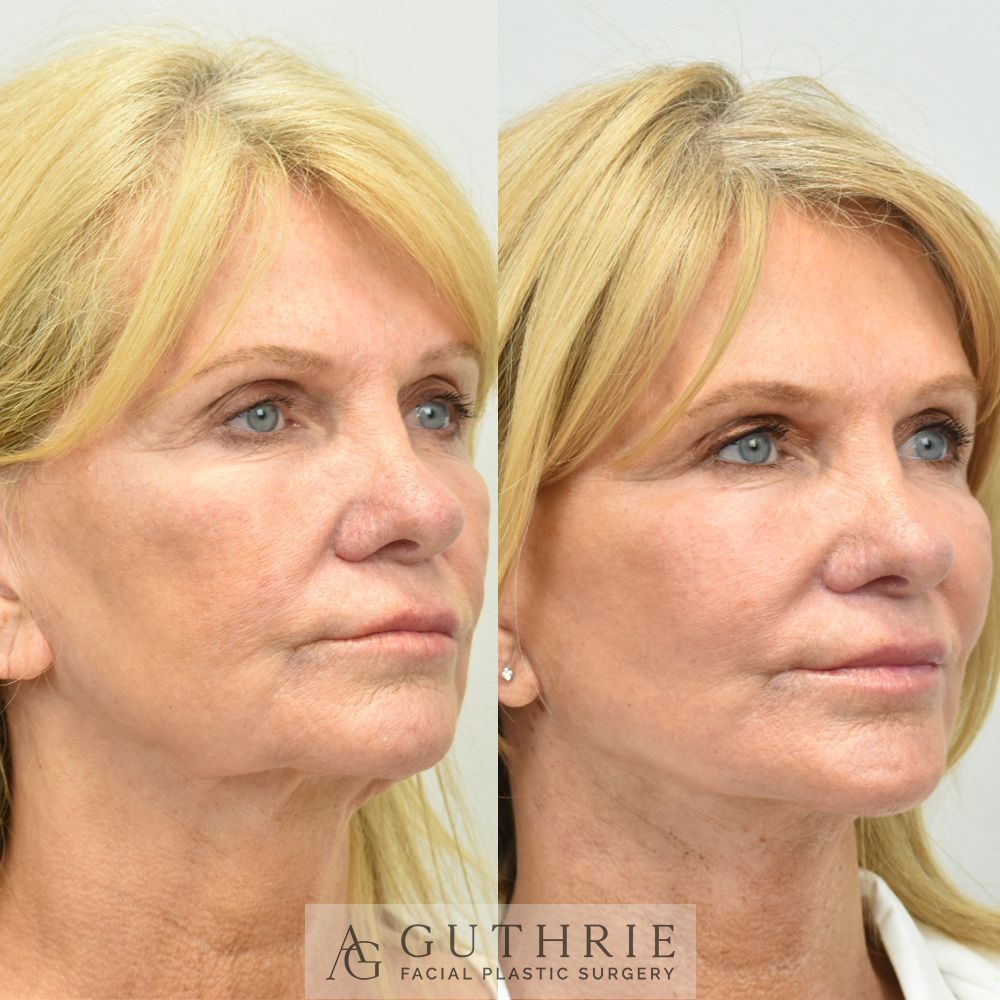 woman's face before and after deep plane facelift performed by Dr. Ashley Guthrie