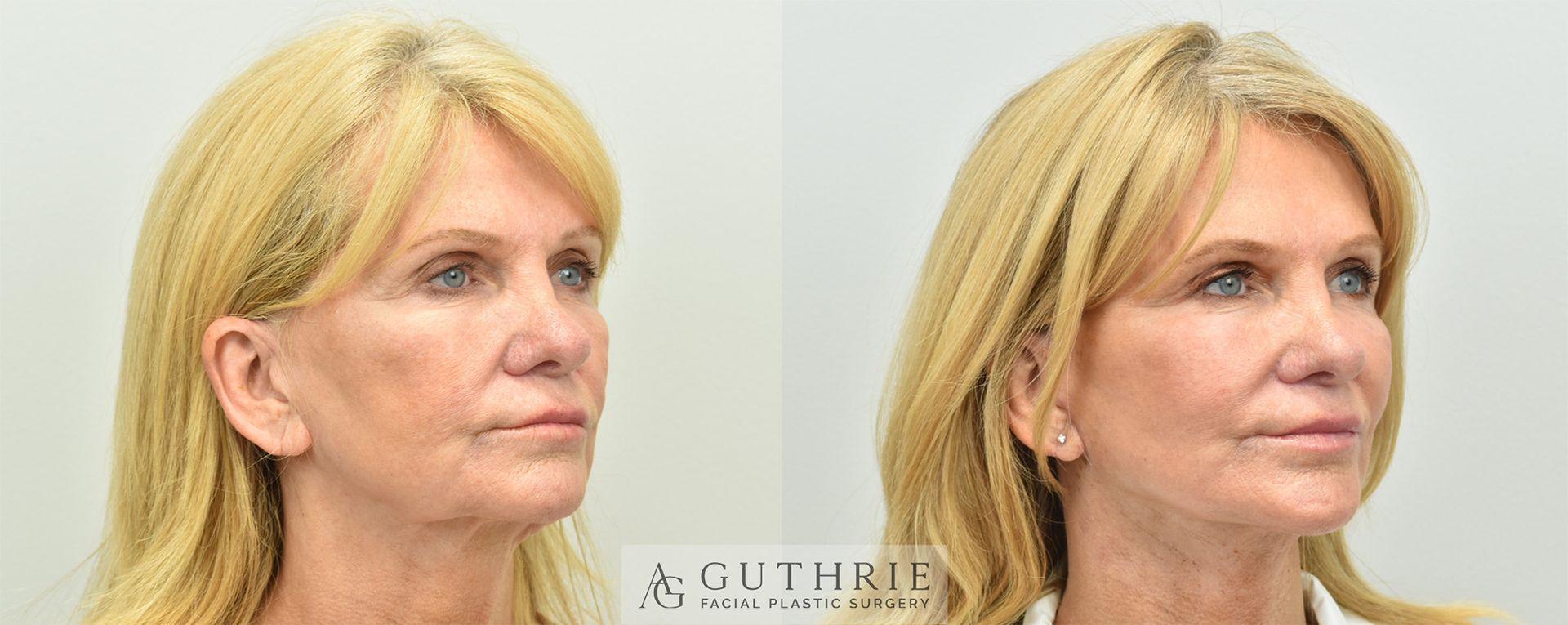 woman's face before and after deep plane facelift performed by Dr. Ashley Guthrie