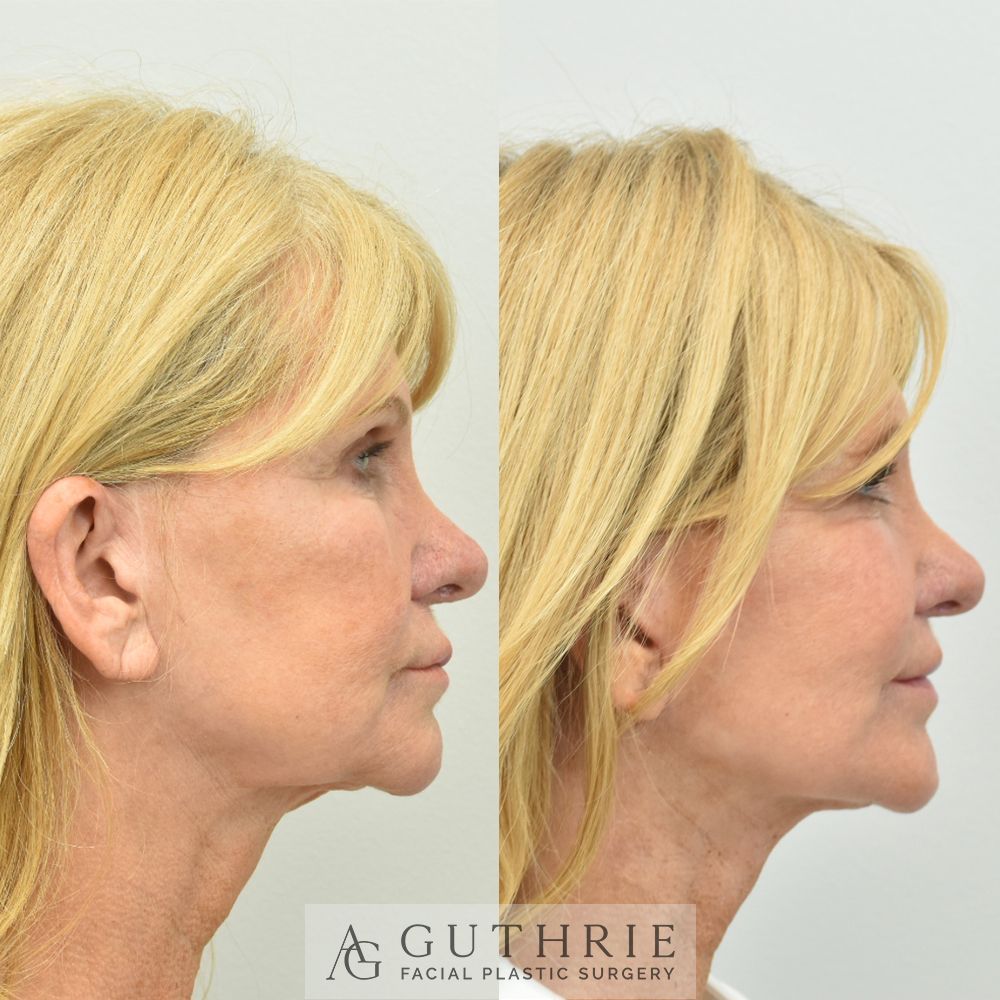woman's face before and after necklift performed by Dr. Ashley Guthrie