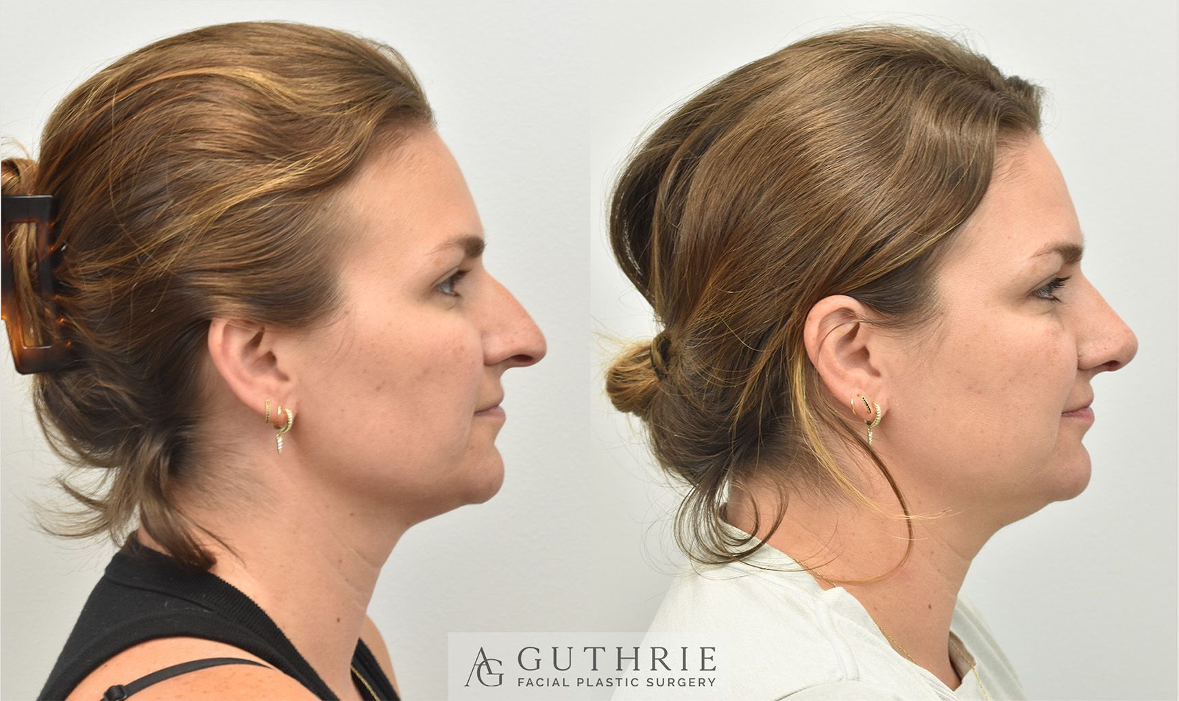 woman's face is shown before and after rhinoplasty performed by Dr. Guthrie