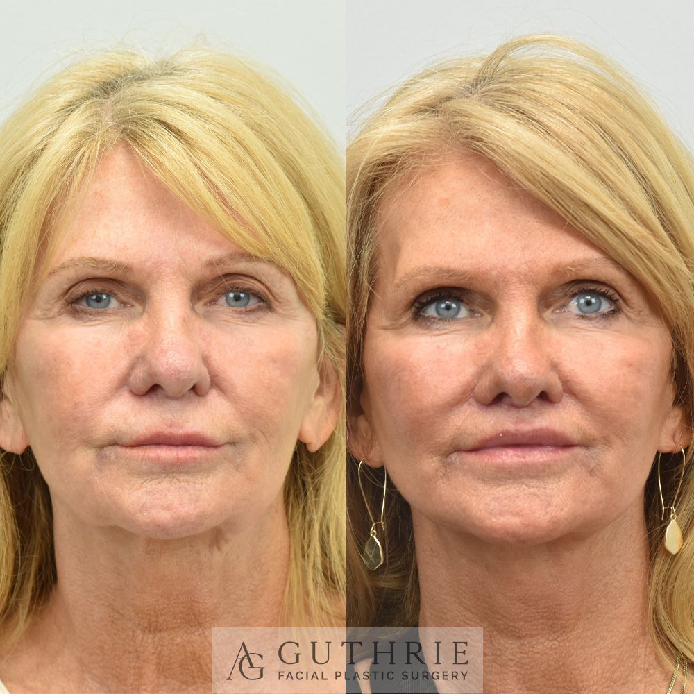 woman before and after Subnasal Lip Lift