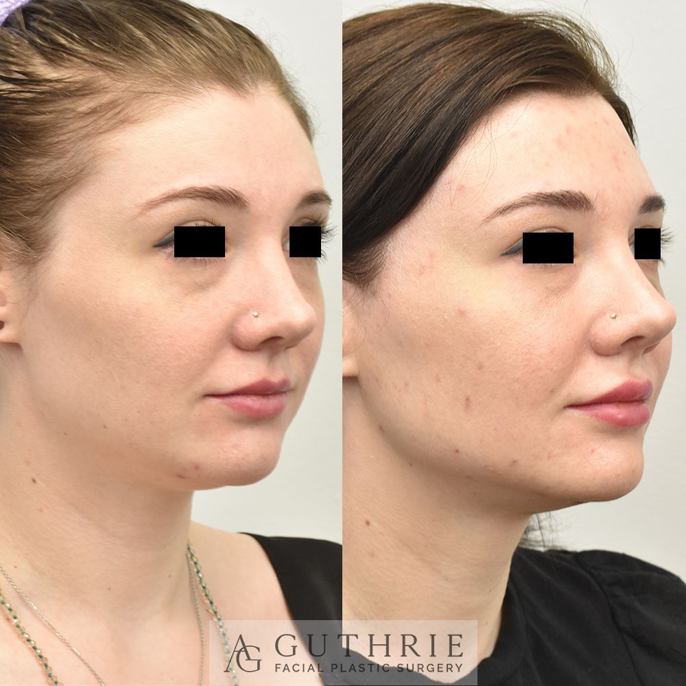 a young woman before and after Submental Liposuction and Buccal Fat Reduction