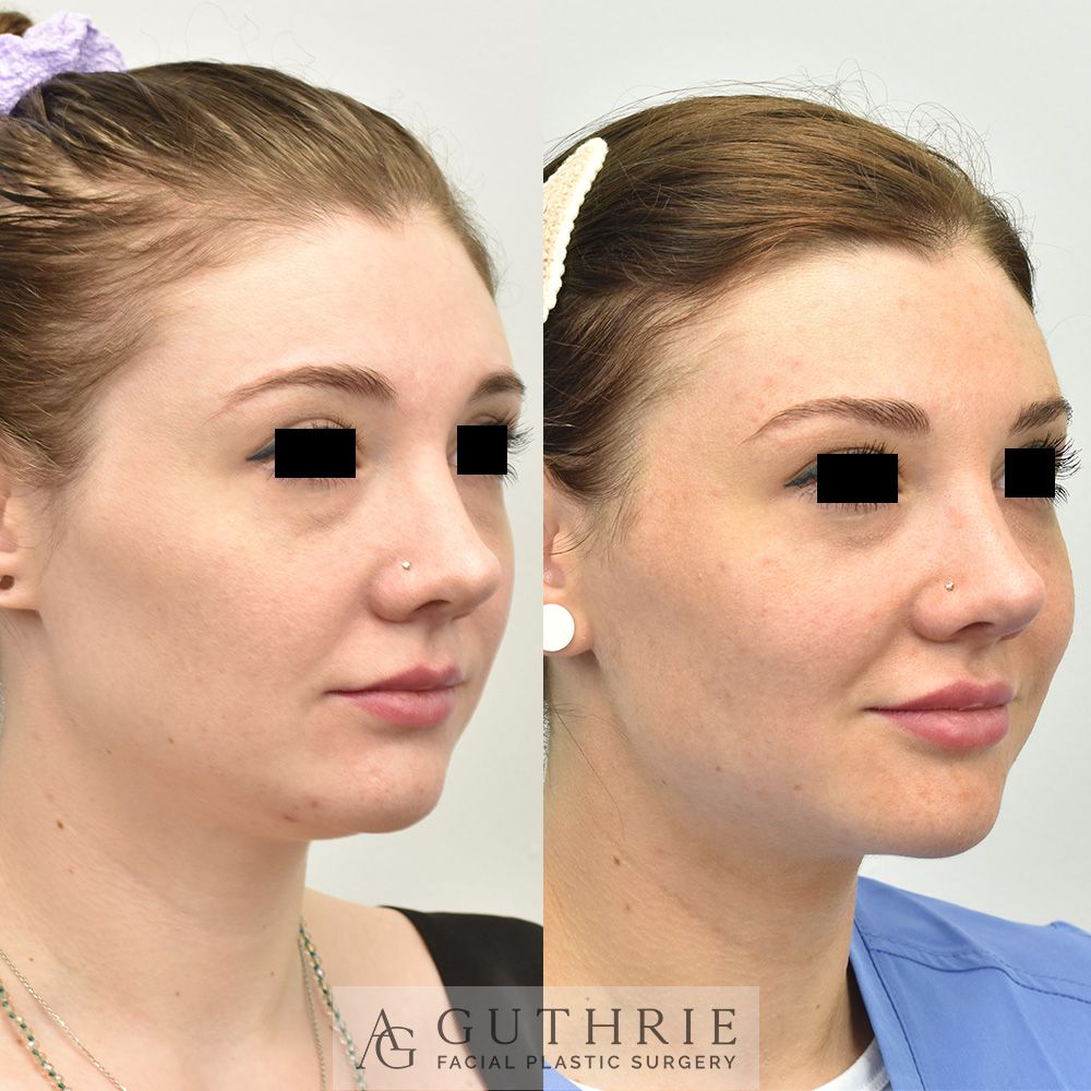 a young woman before and after Submental Liposuction and Buccal Fat Reduction