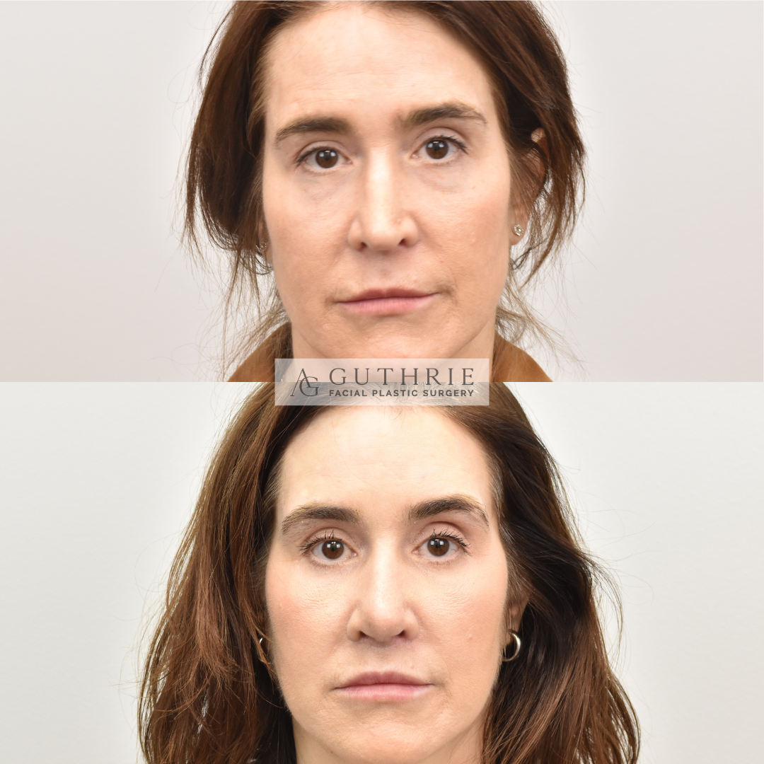 Before and After Brow Lift