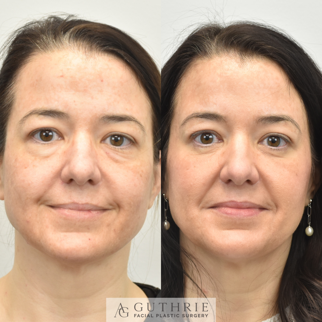 before and after Lower Blepharoplasty and Endoscopic Brow Lift at guthrie facial plastic surgery