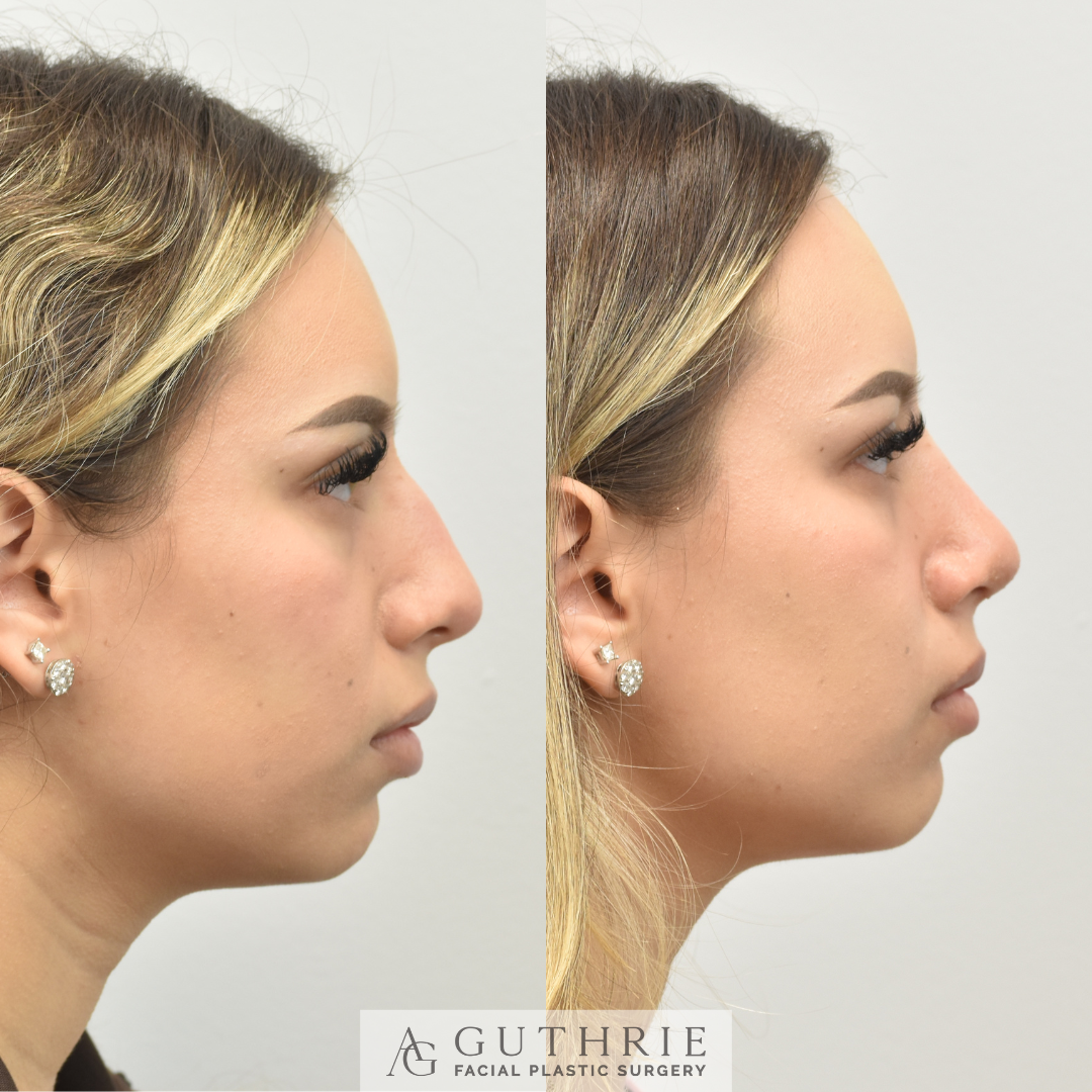 patient at dr guthrie facial plastic surgery in brentwood tn before and after a rhinplasty